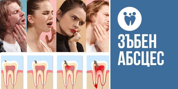 Зъбен абсцес