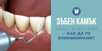 Зъбен камък – защо се образува и как да го елиминираме?