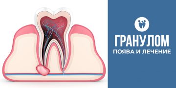 Гранулом – поява и лечение