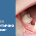 ВИДОВЕ ПРОТЕТИЧНО ЛЕЧЕНИЕ